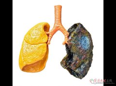 中医痰湿与西医咳嗽咳痰的区别，避免误诊误治的关键要点