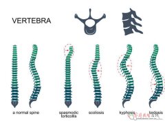 22岁脊柱侧弯如何矫正？非手术与手术治疗全攻略
