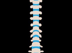 脊椎滑脱治疗方法详解：无症状保守治疗手术选择全攻略