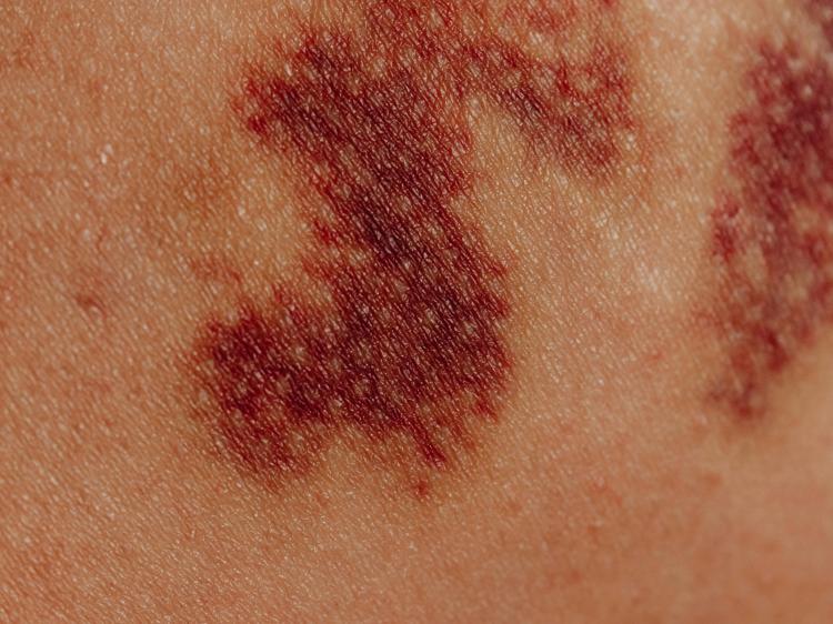 大黄调理瘀血证：3个核心作用+科学使用指南