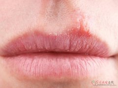 易上火体质调理指南：饮食生活用药三步走告别反复上火