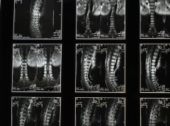 中医辅助调理脊髓炎：3个核心方法提升恢复效果