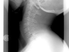 颈椎弹响+突出感：科学区分生理性与病理性